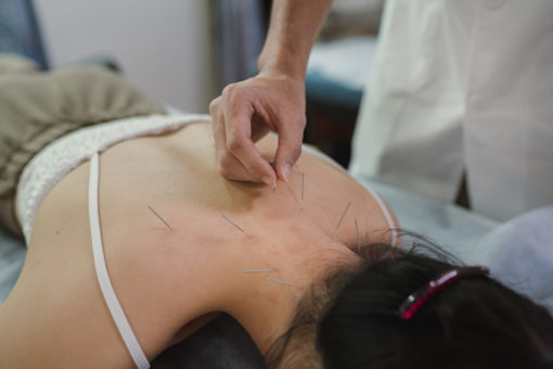 Acupuncture Specialist in Anaheim, California